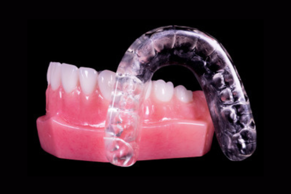 Occlusal Guards And Appliances Pro Craft Dental Laboratory